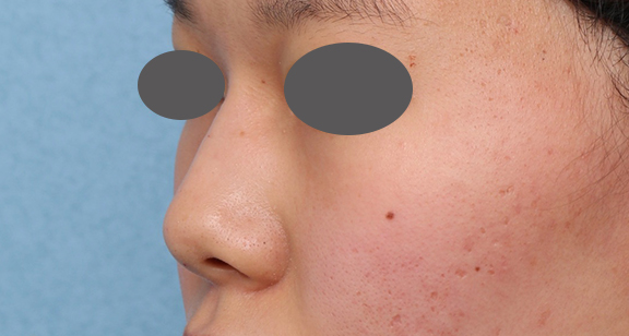 症例写真,隆鼻注射(ヒアルロン酸注射)の症例 高くなりすぎずナチュラルな鼻筋をご希望,After,ba_ryubi2040_b02.jpg