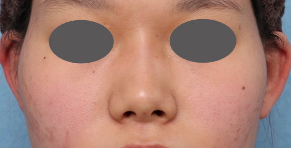 症例写真,隆鼻注射(ヒアルロン酸注射)の症例 高くなりすぎずナチュラルな鼻筋をご希望,After,ba_ryubi2040_b03.jpg