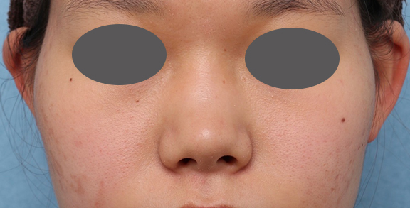 症例写真,隆鼻注射(ヒアルロン酸注射)の症例 高くなりすぎずナチュラルな鼻筋をご希望,Before,ba_ryubi2040_b03.jpg