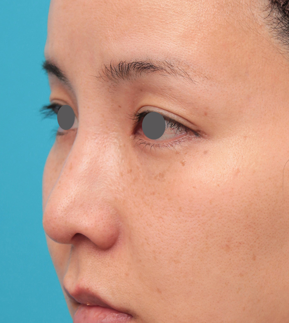 症例写真,鼻先に耳介軟骨移植を行った30代女性の症例写真,After(6ヶ月後),ba_jikai046_b02.jpg
