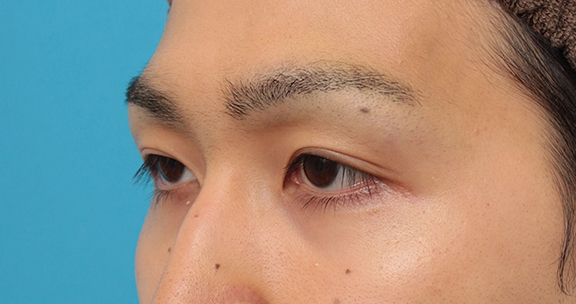 症例写真,眼瞼下垂の症例写真,After(3ヶ月後),ba_ganken043_b03.jpg
