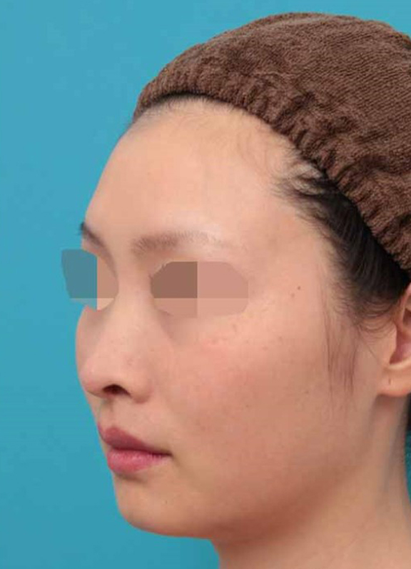 症例写真,鼻中隔延長術の症例写真,After（6ヶ月後）,ba_bichukaku005_b03.jpg