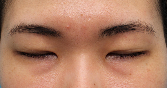 目頭切開,二重まぶた・全切開法+目頭切開の症例写真,Before,ba_sekkai081_b02.jpg