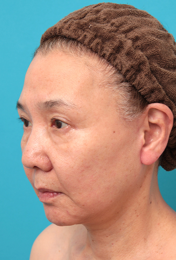 フルフェイスリフト,フルフェイスリフトを行った60代女性の症例写真,After(6ヶ月後),ba_facelift007_b02.jpg