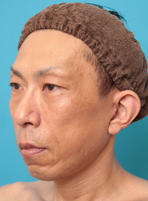 症例写真,ミディアムフェイスリフトでリフトアップした50代男性の症例写真,After(6ヶ月後),ba_mediumlift018_b02.jpg