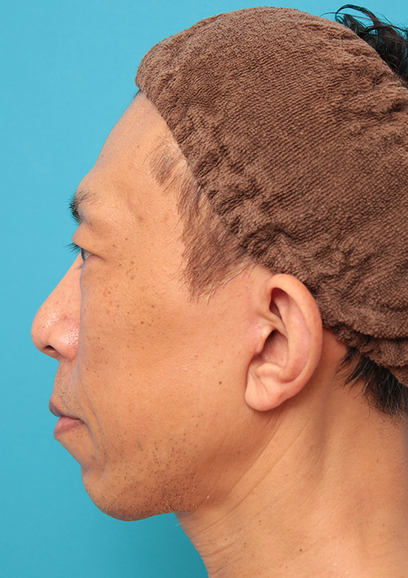 症例写真,ミディアムフェイスリフトでリフトアップした50代男性の症例写真,After(6ヶ月後),ba_mediumlift018_b03.jpg