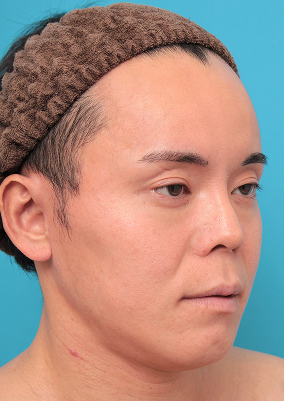 症例写真,ミディアムフェイスリフトを行った30代後半男性の症例写真,After(6ヶ月後),ba_mediumlift019_b02.jpg