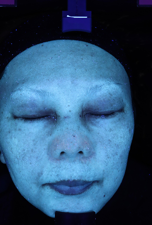 症例写真,ピコレーザーで治療した症例写真,After UVカメラ<br/>
(1週間後),ba_picoway002_b02.jpg