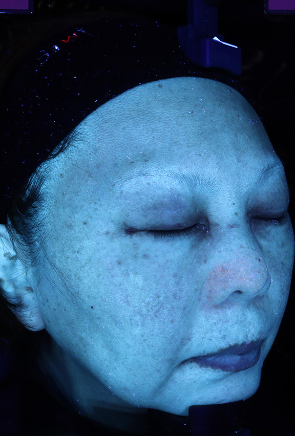 症例写真,ピコレーザーで治療した症例写真,After UVカメラ<br/>
(1週間後),ba_picoway002_b04.jpg