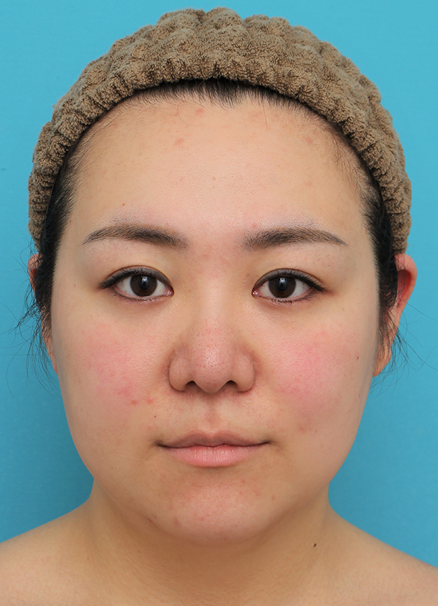 脂肪吸引（頬、あご下）,頬～フェイスライン～顎下の脂肪吸引をした20代女性の症例写真,手術前,mainpic_shibokyuin047a.jpg