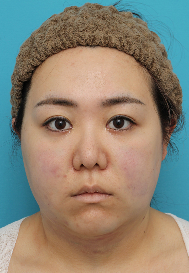 脂肪吸引（頬、あご下）,頬～フェイスライン～顎下の脂肪吸引をした20代女性の症例写真,手術直後,mainpic_shibokyuin047b.jpg