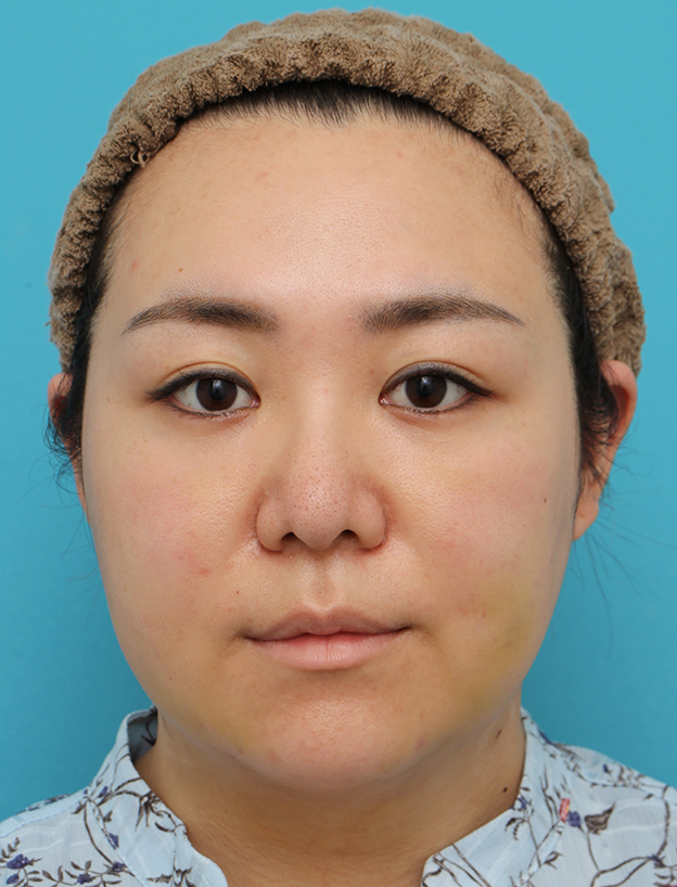 脂肪吸引（頬、あご下）,頬～フェイスライン～顎下の脂肪吸引をした20代女性の症例写真,1週間後,mainpic_shibokyuin047c.jpg