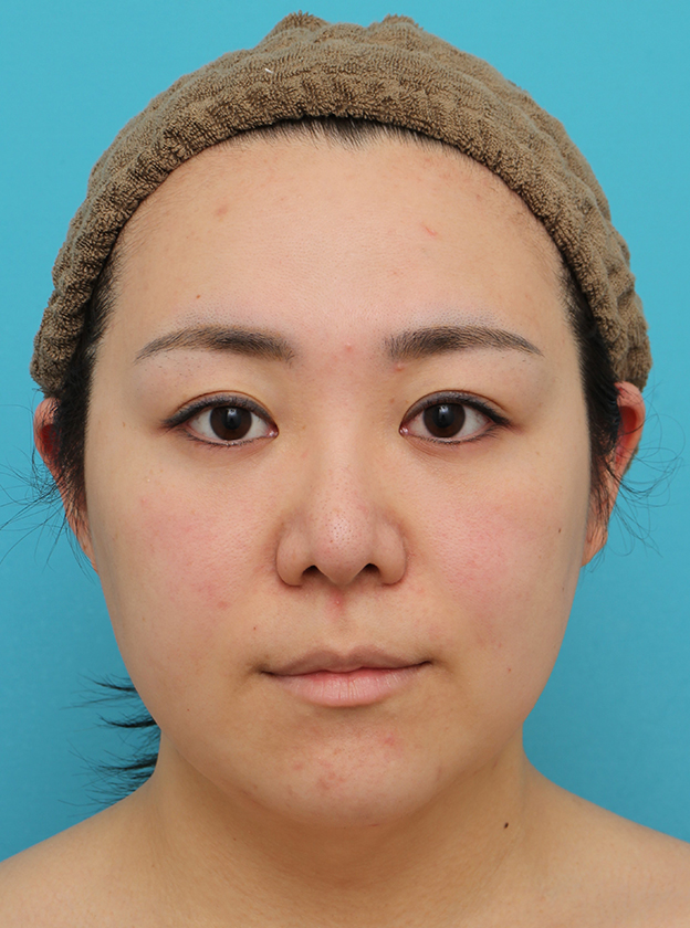 脂肪吸引（頬、あご下）,頬～フェイスライン～顎下の脂肪吸引をした20代女性の症例写真,3週間後,mainpic_shibokyuin047d.jpg