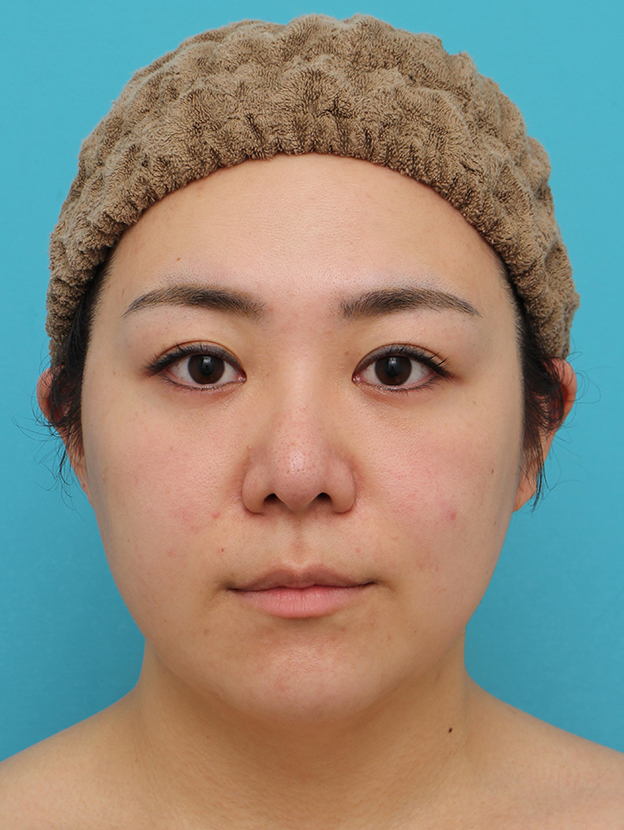 脂肪吸引（頬、あご下）,頬～フェイスライン～顎下の脂肪吸引をした20代女性の症例写真,3ヶ月後,mainpic_shibokyuin047e.jpg