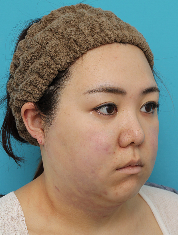 脂肪吸引（頬、あご下）,頬～フェイスライン～顎下の脂肪吸引をした20代女性の症例写真,手術直後,mainpic_shibokyuin047g.jpg