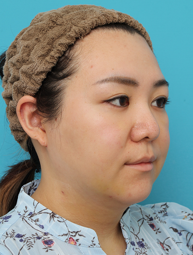 脂肪吸引（頬、あご下）,頬～フェイスライン～顎下の脂肪吸引をした20代女性の症例写真,1週間後,mainpic_shibokyuin047h.jpg