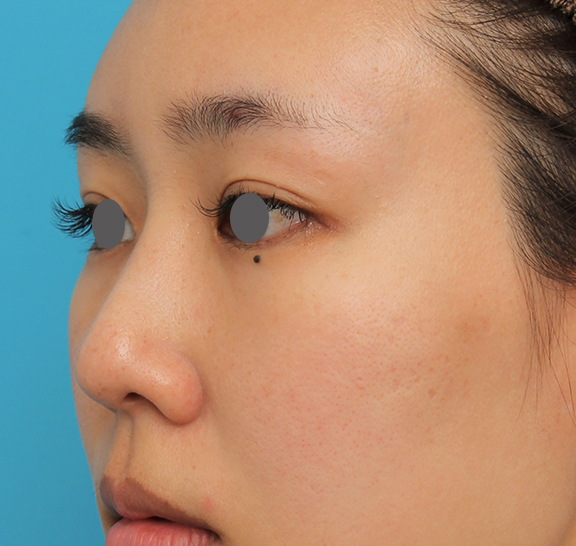 症例写真,ハンプ切除+鼻骨切り幅寄せ+鼻尖縮小を行った20代女性の症例写真,After(4ヶ月後),ba_hump015_b03.jpg