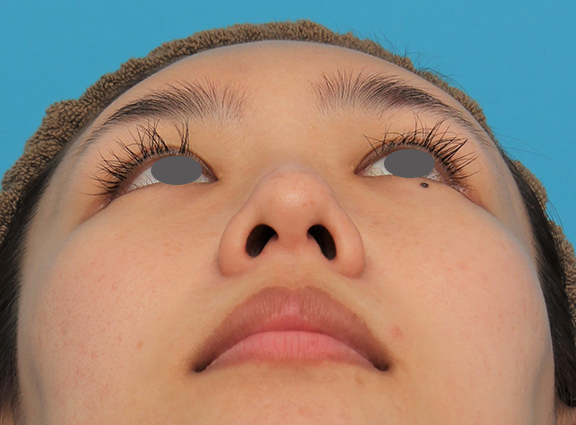 症例写真,ハンプ切除+鼻骨切り幅寄せ+鼻尖縮小を行った20代女性の症例写真,After(4ヶ月後),ba_hump015_b04.jpg