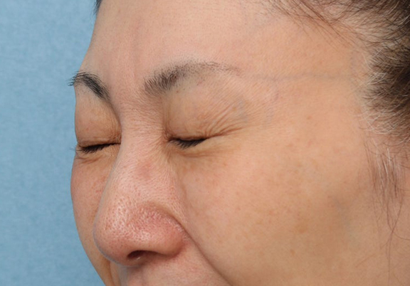 症例写真,目元のシワにボトックス注射を行った症例写真,After(1ヶ月後),ba_botox019_b02.jpg
