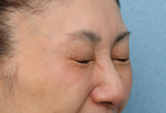 症例写真,目元のシワにボトックス注射を行った症例写真,After(1ヶ月後),ba_botox019_b03.jpg