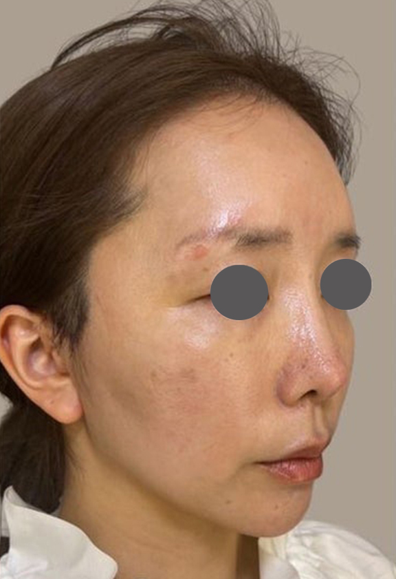 ミニフェイスリフト(頬のたるみ取り),30代のたるみの少ない方のミニフェイスリフトの症例写真,After(1ヶ月後),ba_minilift015_b02.jpg