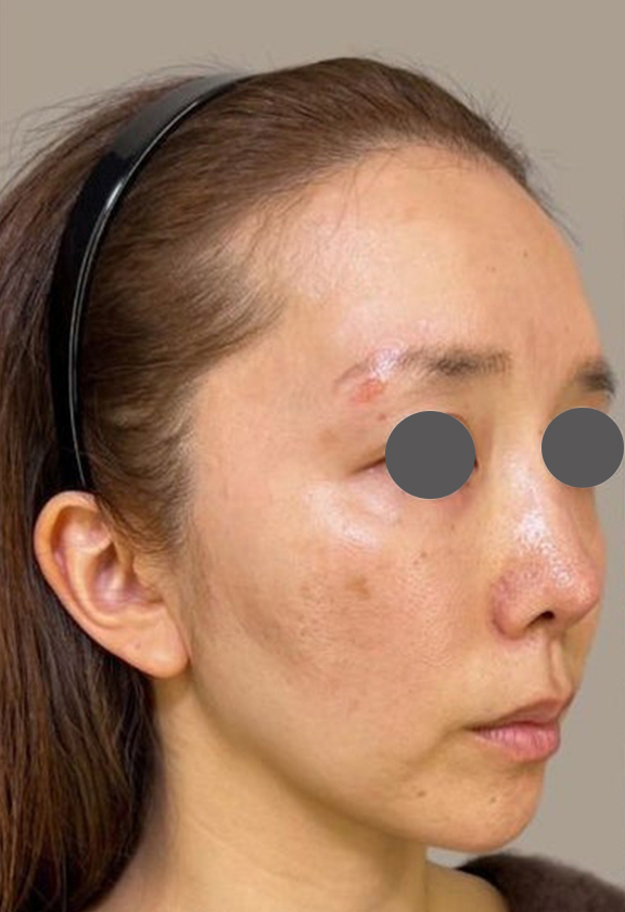ミニフェイスリフト(頬のたるみ取り),30代のたるみの少ない方のミニフェイスリフトの症例写真,Before,ba_minilift015_b02.jpg