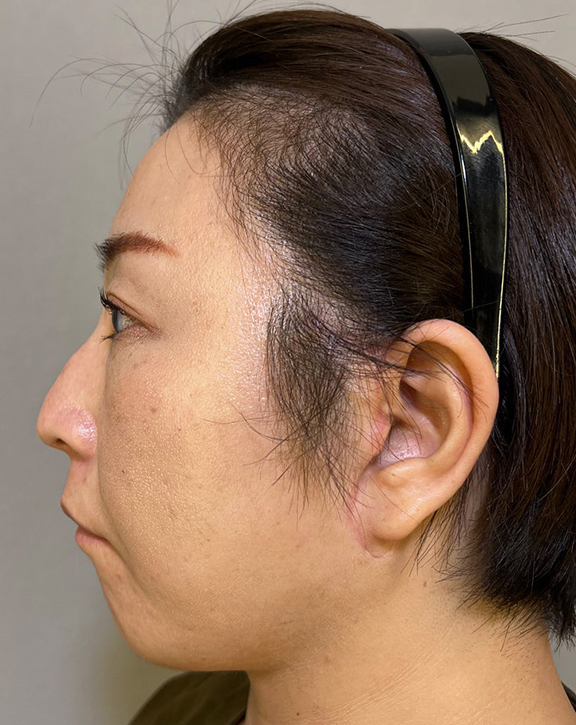 ミニフェイスリフト(頬のたるみ取り),ミニフェイスリフトで口元のたるみを改善した女性の症例写真,After(3ヶ月後),ba_minilift016_b02.jpg