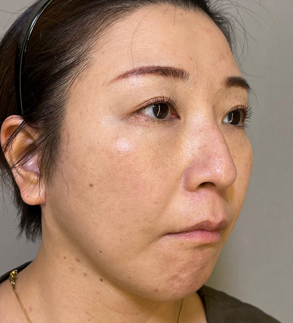 ミニフェイスリフト(頬のたるみ取り),ミニフェイスリフトで口元のたるみを改善した女性の症例写真,After(3ヶ月後),ba_minilift016_b03.jpg