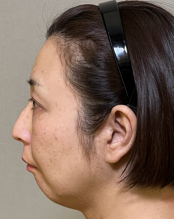ミニフェイスリフト(頬のたるみ取り),ミニフェイスリフトで口元のたるみを改善した女性の症例写真,Before,ba_minilift016_b02.jpg