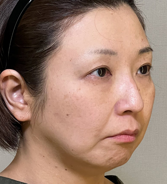 ミニフェイスリフト(頬のたるみ取り),ミニフェイスリフトで口元のたるみを改善した女性の症例写真,Before,ba_minilift016_b03.jpg