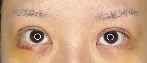 症例写真,他院で行った埋没法のまぶたを二重まぶた・全切開法で修正した20代女性の症例写真,術後1週間後,mainpic_sekkai095b.jpg