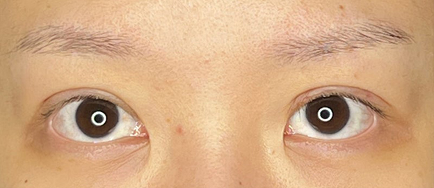 症例写真,他院で行った埋没法のまぶたを二重まぶた・全切開法で修正した20代女性の症例写真,術後1ヶ月後,mainpic_sekkai095c.jpg