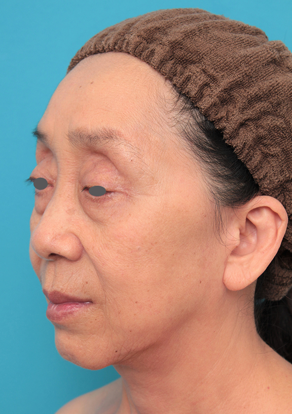 症例写真,ミディアムフェイスリフトを行った60代女性の症例写真,After(6ヶ月後),ba_mediumlift023_b02.jpg
