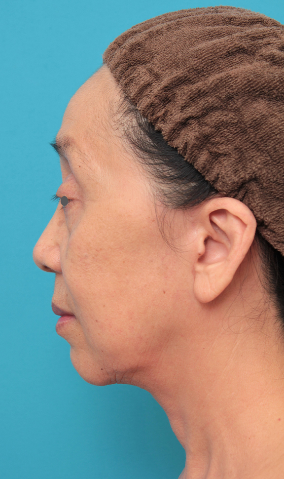 症例写真,ミディアムフェイスリフトを行った60代女性の症例写真,After(6ヶ月後),ba_mediumlift023_b03.jpg