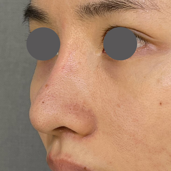 症例写真,鼻を小さく細く見せるために隆鼻術(シリコンプロテーゼ)を行った症例写真,After(3ヶ月後),ba_ryubi1064_b02.jpg