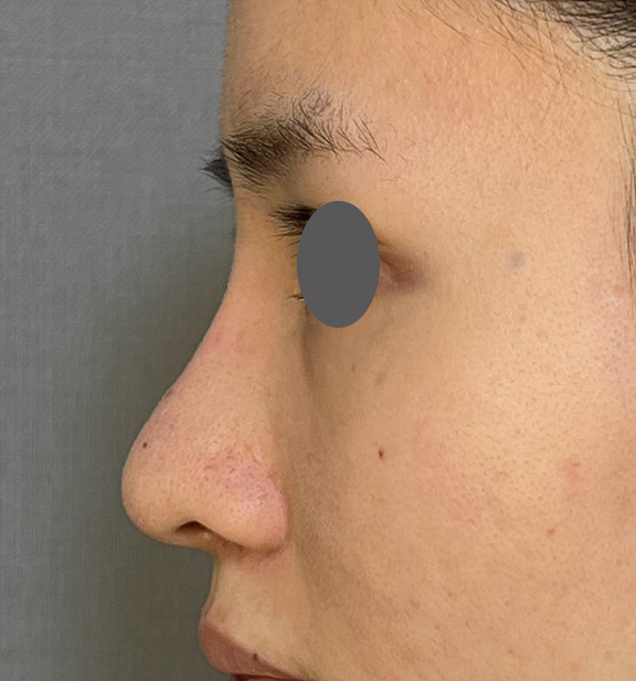 症例写真,鼻を小さく細く見せるために隆鼻術(シリコンプロテーゼ)を行った症例写真,After(3ヶ月後),ba_ryubi1064_b03.jpg