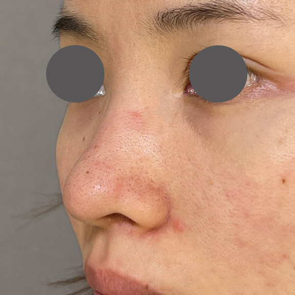 症例写真,鼻を小さく細く見せるために隆鼻術(シリコンプロテーゼ)を行った症例写真,Before,ba_ryubi1064_b02.jpg