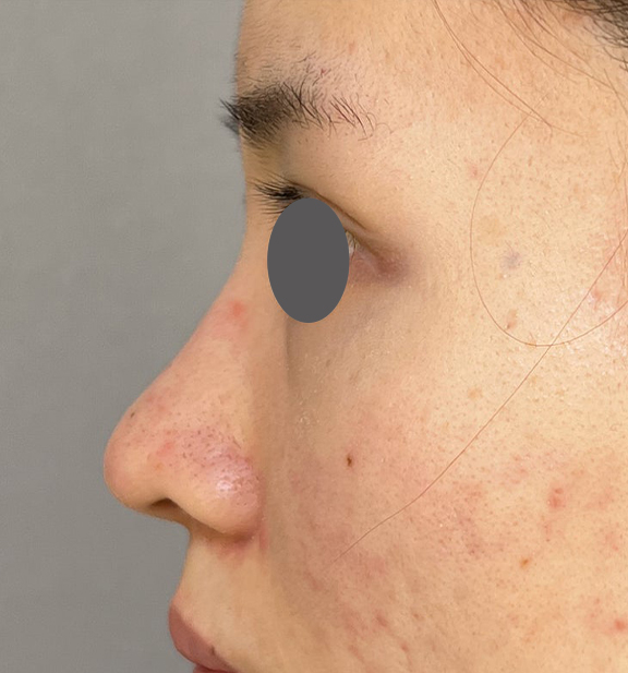 症例写真,鼻を小さく細く見せるために隆鼻術(シリコンプロテーゼ)を行った症例写真,Before,ba_ryubi1064_b03.jpg