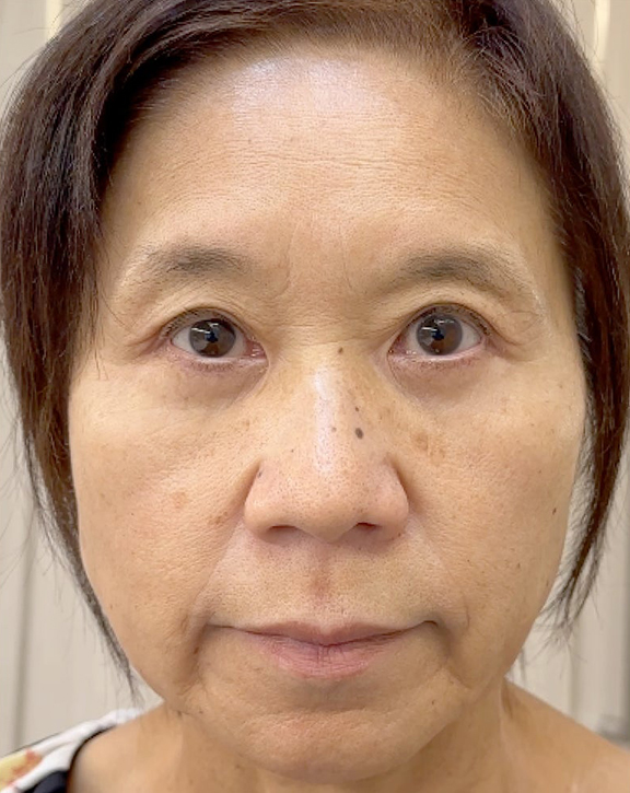 症例写真,強い窪み目と目の開けづらさを改善した眼瞼下垂の症例写真,After(3ヶ月後),ba_ganken046_b02.jpg