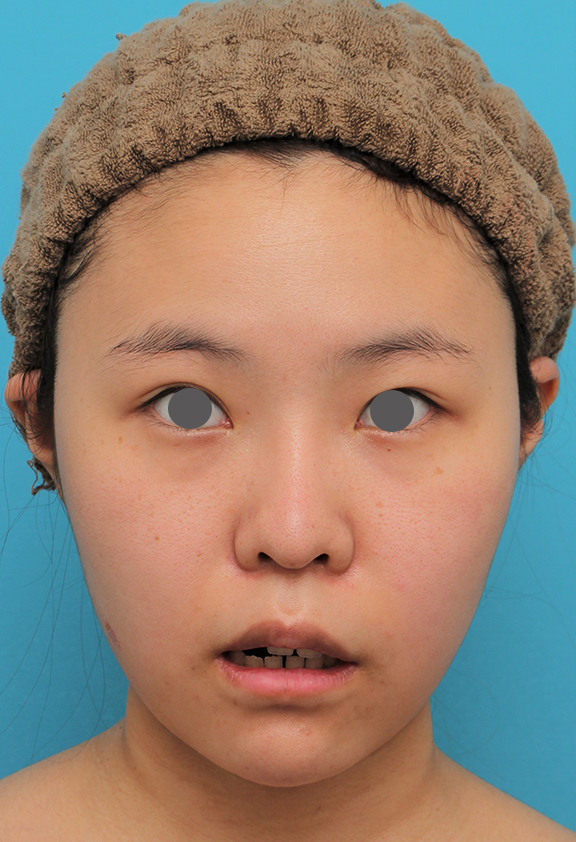 あご形成(シリコンプロテーゼ),顎シリコンプロテーゼ+下唇薄くする手術を行った20代女性の症例写真,After(2ヶ月後),ba_ago025_b02.jpg