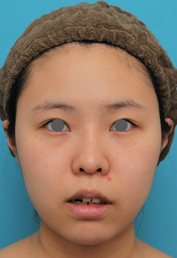 あご形成(シリコンプロテーゼ),顎シリコンプロテーゼ+下唇薄くする手術を行った20代女性の症例写真,Before,ba_ago025_b02.jpg
