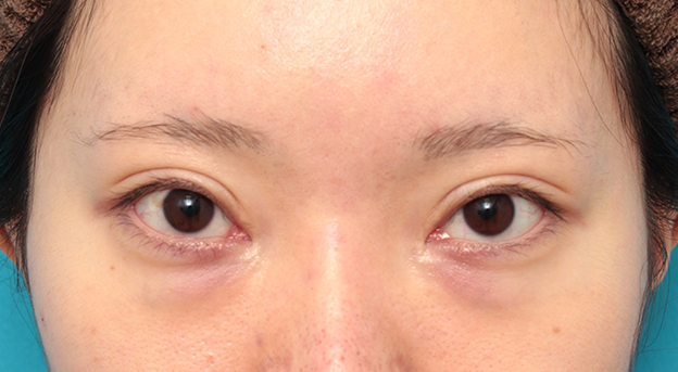 症例写真,タレ目形成手術(グラマラスライン)と目の下脂肪取り(脱脂)を同時に行った20代女性の症例写真,手術前,mainpic_panda024a.jpg