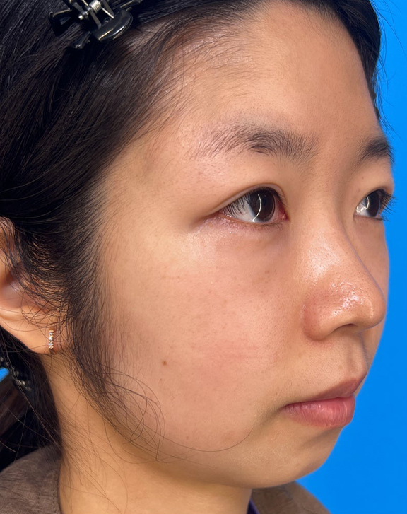 症例写真,ピコレーザーで赤みとシミを改善した症例写真,After(2ヶ月後),ba_picoway003_b03.jpg