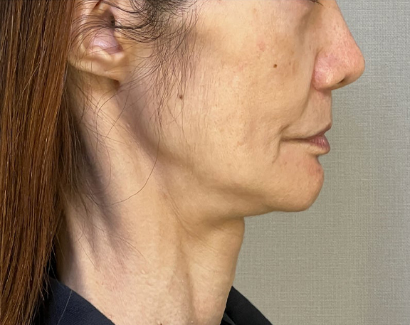 ミニフェイスリフト(頬のたるみ取り),ミニフェイスリフトで頬のたるみを改善した症例写真,Before,ba_minilift018_b03.jpg
