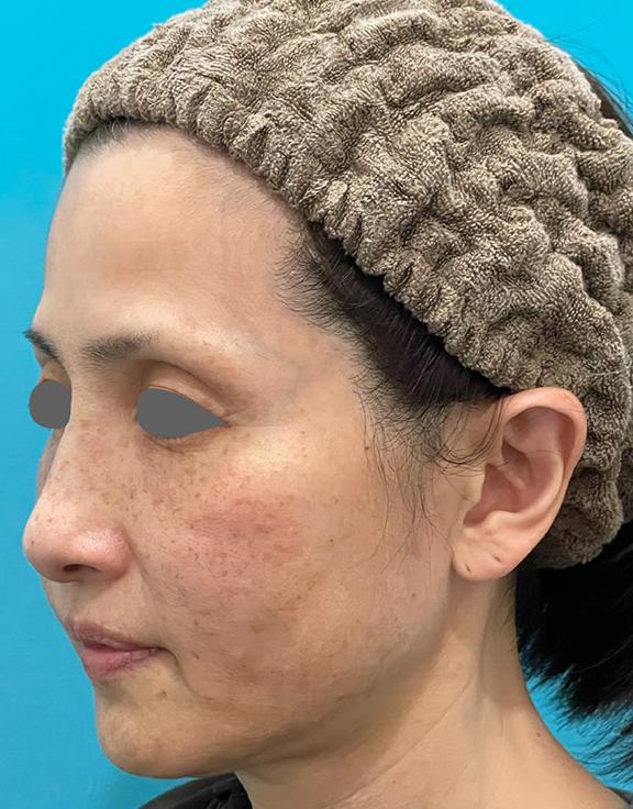 症例写真,フォトフェイシャルM22でシミを改善した症例写真,Before,ba_ipl014_b02.jpg