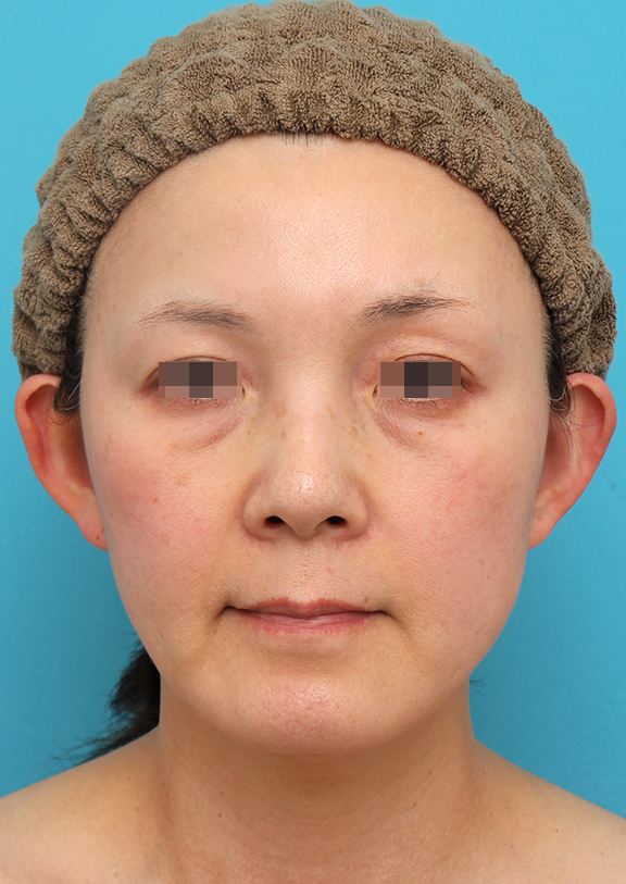 ミニフェイスリフト（頬のたるみ取り）,ミニフェイスリフトを行った50代女性症例写真,After（6ヶ月後）,ba_minilift019_a01.jpg
