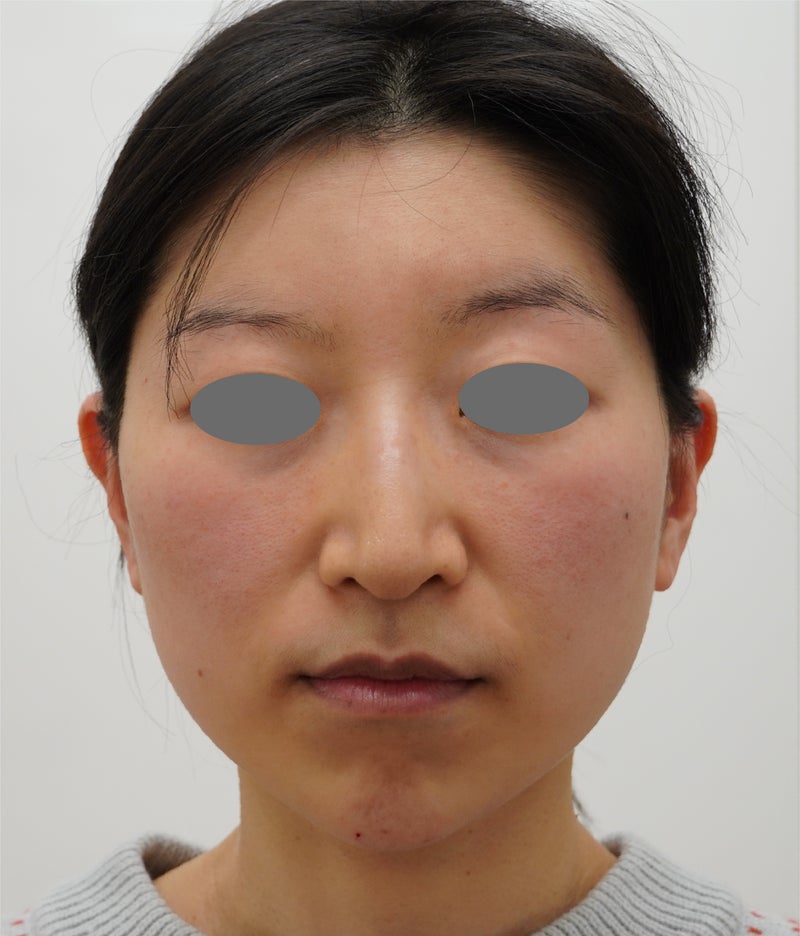 ミニフェイスリフト(頬のたるみ取り),ミニリフト、脂肪吸引、あごヒアルロン酸でフェイスラインをすっきりさせ、1年後も効果が持続している症例写真,After(1年後),ba_minilift021_b02.jpg