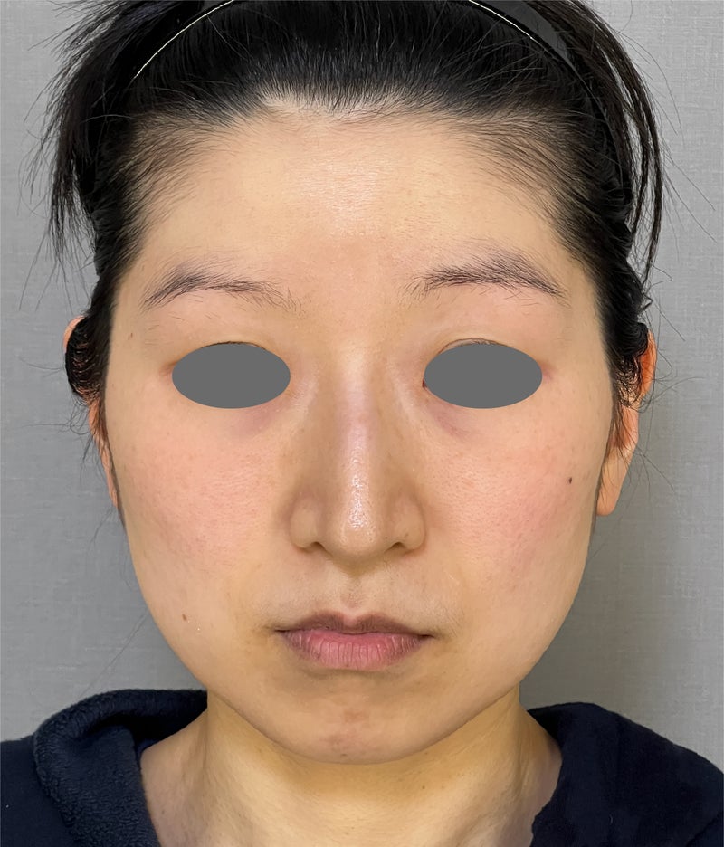 ミニフェイスリフト(頬のたるみ取り),ミニリフト、脂肪吸引、あごヒアルロン酸でフェイスラインをすっきりさせ、1年後も効果が持続している症例写真,Before,ba_minilift021_b02.jpg