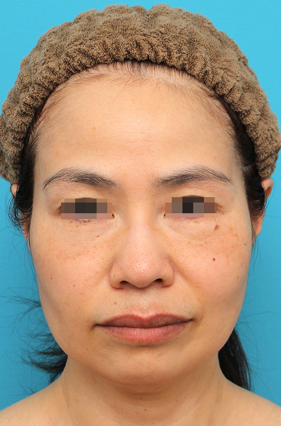 ミディアムフェイスリフト,ミディアムフェイスリフトを行った50代女性の症例写真,Before,ba_mediumlift025_b01.jpg