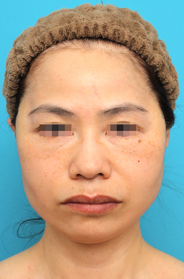 ミディアムフェイスリフト,ミディアムフェイスリフトを行った50代女性の症例写真,手術直後,mainpic_mediumlift025b.jpg